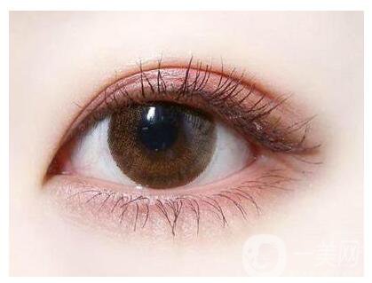 切開雙眼皮適合人群有哪些呢？