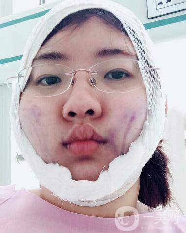 成都等離子光纖溶脂