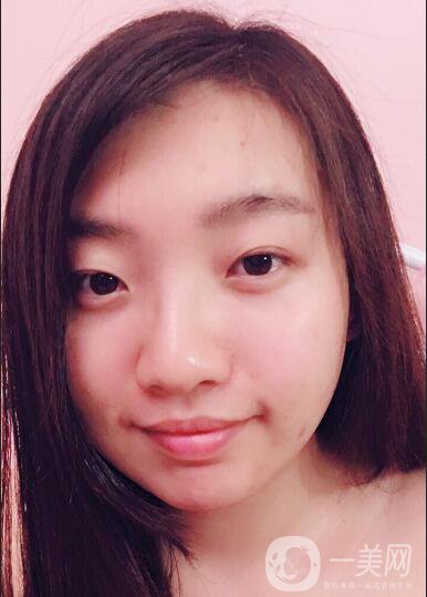 等離子光纖溶脂