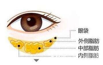 光乳化去眼袋多少錢呢?