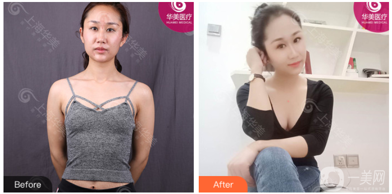 上海華美謝衛(wèi)國(guó)隆胸案例