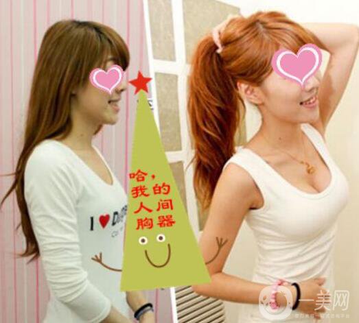 上海玫瑰院長李鴻君隆胸案例