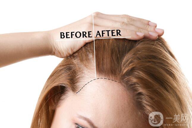 瀘州毛發(fā)移植價格是多少錢