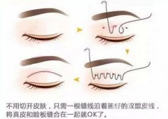 北京埋線雙眼皮修復(fù)價(jià)格盤點(diǎn)
