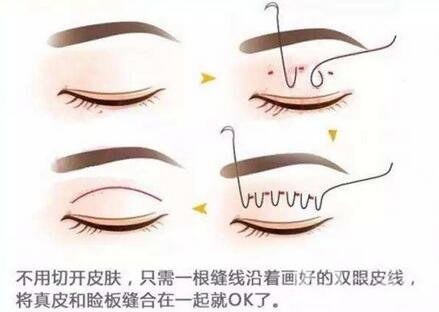 北京埋線雙眼皮修復(fù)價格盤點