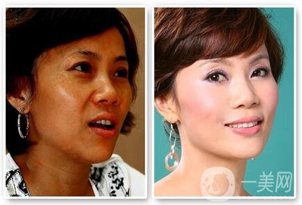 彩光嫩膚*嗎？對(duì)人體有害嗎？