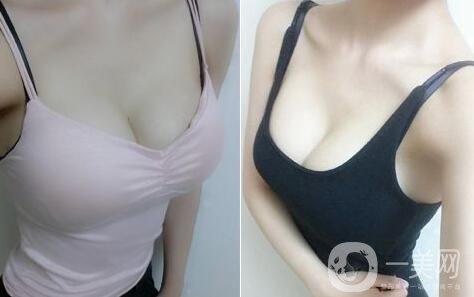 假體隆胸術(shù)有哪些特點？