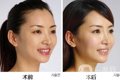 鐳射美膚副作用有哪些？