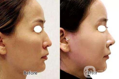 瑞蘭玻尿酸隆鼻價格多少錢？貴嗎？