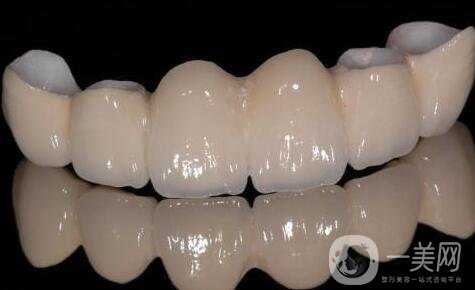 北京烤瓷牙價(jià)格及種類詳情?