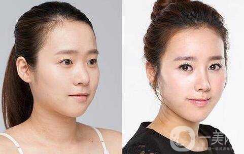 北京隆鼻價(jià)格大概是多少錢(qián)?