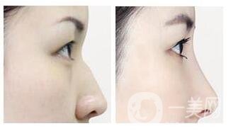 北京隆鼻價(jià)格大概是多少錢(qián)?