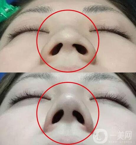 鼻頭鼻翼縮小多久能看到*果?