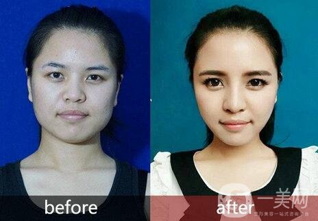 光纖溶脂瘦臉多久恢復(fù)?恢復(fù)期要注意什么?