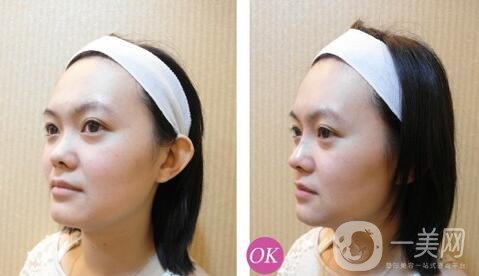 隆高鼻梁會(huì)不會(huì)肉不夠?醫(yī)生是怎么做的?