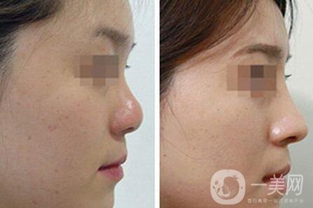 隆高鼻梁會(huì)不會(huì)肉不夠?醫(yī)生是怎么做的?