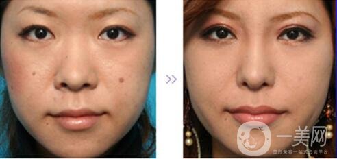 鼻翼縮小手術(shù)恢復(fù)過程