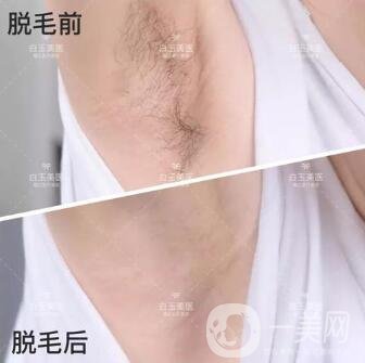 激光脫毛手術(shù)要多少錢一次？