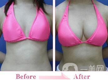 假體隆胸的技術(shù)目前已經(jīng)比較成熟，有些愛美的女士在胸部位置，想要借助假體，來擴(kuò)大胸部的*果。 為了讓自己能夠突出獨(dú)特象征的身材，想到的方法就是選擇進(jìn)行假體隆胸手術(shù)，通過做假體隆胸手術(shù)，可以讓我們擁有傲人的身姿。毛面隆胸假體外層有組紋，有種磨砂的手感，它的其在特點(diǎn)是可允許組織粘在表面，這樣*降低包膜縮小的可能，其中相對(duì)價(jià)格比其他的貴一些。