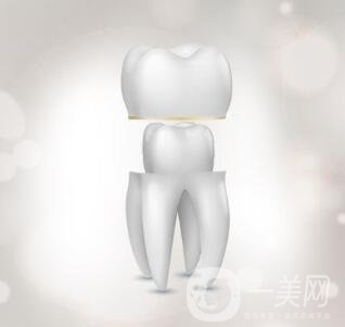 烤瓷牙的種類和優(yōu)缺點分別是什么呢？