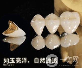 烤瓷牙的種類和優(yōu)缺點分別是什么呢？