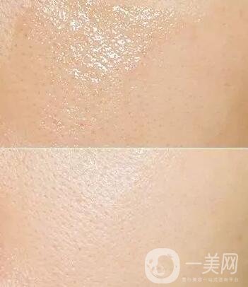 光子嫩膚去毛孔能維持多久?