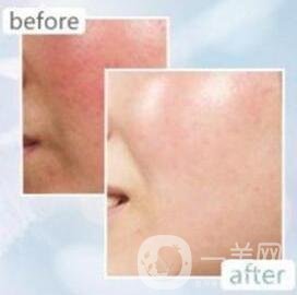 光子去紅血絲多久見(jiàn)*?恢復(fù)過(guò)程是怎樣的?