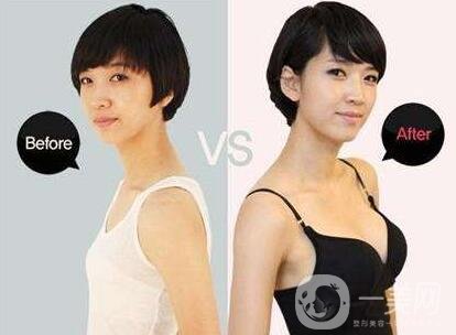 麥格假體隆胸多少錢?費(fèi)用貴嗎?