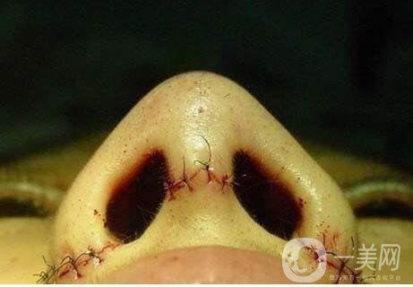 內(nèi)切鼻翼縮小多久才能恢復(fù)？是否會(huì)留下疤痕？