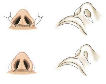 內(nèi)切鼻翼縮小多久才能恢復(fù)？是否會(huì)留下疤痕？