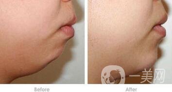 硅膠墊下巴排異癥狀有哪些？怎樣才知道排異了？