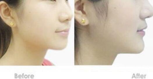 硅膠墊下巴硬得像石頭，多久能恢復(fù)？