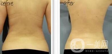 后背吸脂1000毫升多嗎？有*的瘦背*果嗎？
