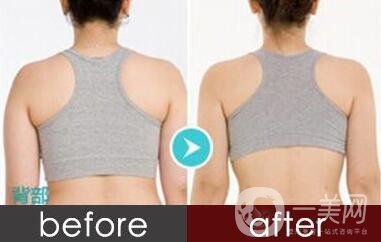 后背吸脂1000毫升多嗎？有*的瘦背*果嗎？