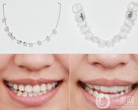 3m半隱形牙套價(jià)格多少錢?貴嗎?