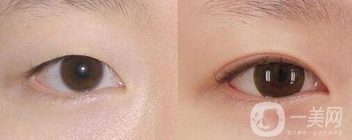 阿爾法美眼術過程是怎么做的?