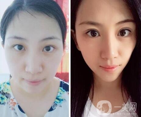 阿爾法美眼術過程是怎么做的?