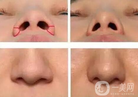 鼻孔太大了怎么變小一點?