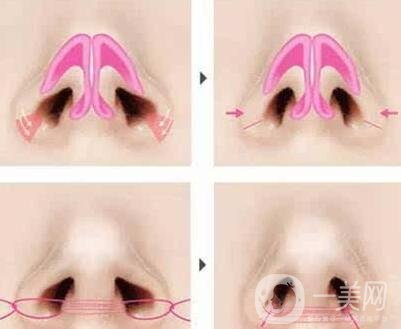 鼻孔太大了怎么變小一點?