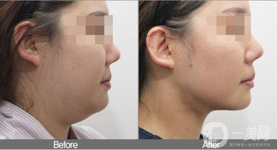 雙下巴吸脂不戴頭套有什么后果?