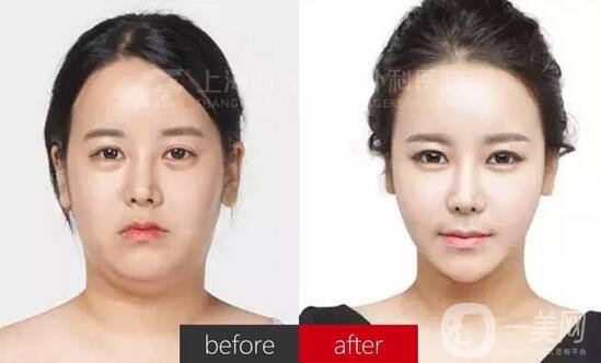 雙下巴吸脂后一個(gè)月還是有雙下巴，是失敗了嗎?