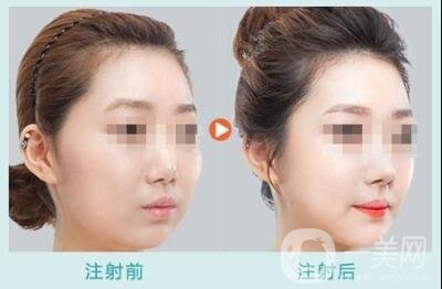 玻尿酸豐太陽穴