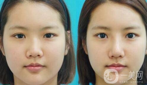 鼻翼縮小手術(shù)