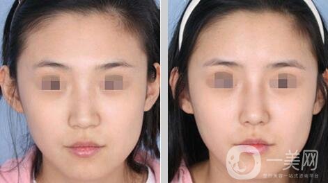 鼻翼縮小手術(shù)