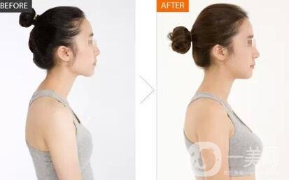 隆胸假體取出有沒有后遺癥？要怎么護(hù)理？