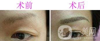 眉毛種植選什么時候是成活率比較高?