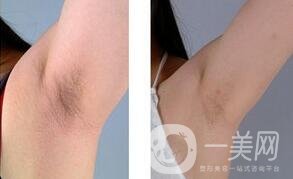 蜜蠟脫毛會越來越粗嗎？