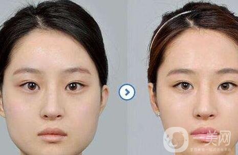 哪家醫(yī)院做削骨手術(shù)比較*？正規(guī)醫(yī)院怎么選？