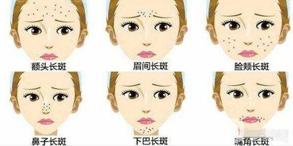 激光祛斑的優(yōu)勢(shì)有哪些?為什么這么多人去做?