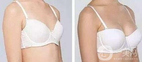 假體隆胸具體有哪些方法?材料不同方法不同?